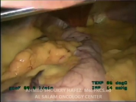 Gastrectomía en manga laparoscópica para el tratamiento de la obesidad mórbida