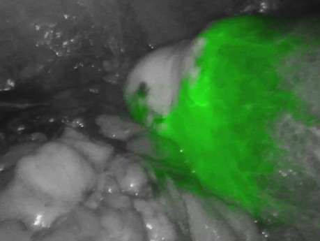 Anastomosis después de la prueba de perfusión ICG en hemicolectomía derecha