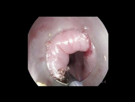 Diverticulectomía por dehiscencia de Killian (miotomía)