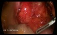 Teratoma retroperitoneal