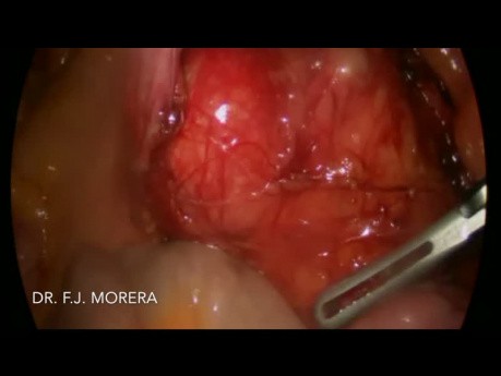 Teratoma retroperitoneal