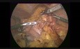 Gastrectomía subtotal radical laparoscópica D2