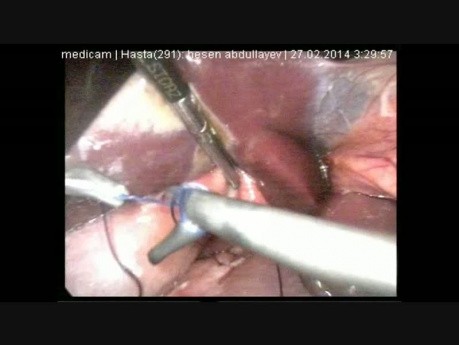Reparación laparoscópica de úlcera péptica perforada
