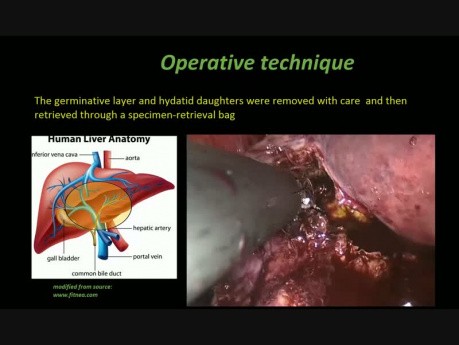 Tratamiento laparoscópico de un gran quiste hepático hidatico central (con dibujos)