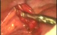Lesión abdominal con prolapso del epiplón y perforación intestinal