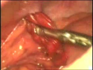 Lesión abdominal con prolapso del epiplón y perforación intestinal