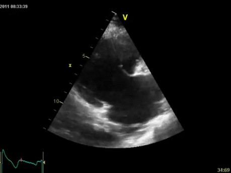 Insuficiencia tricuspídea libre