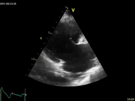 Insuficiencia tricuspídea libre