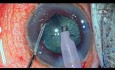Cirugía de Catarata en ojo con Pseudoexfoliación y Cierre Angular Primario