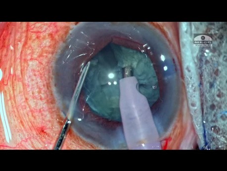 Cirugía de Catarata en ojo con Pseudoexfoliación y Cierre Angular Primario