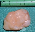 Pólipo coanal que surge del tabique posterior [pieza quirúrgica]