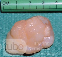 Pólipo coanal que surge del tabique posterior [pieza quirúrgica]