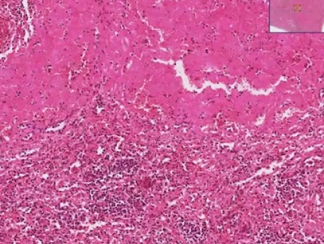 Amiloidosis - histopatologia - hígado