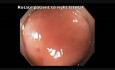 Complicaciones de la resección mucosa endoscópica (RME) - sangrado del ciego - video D