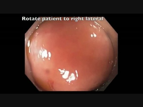 Complicaciones de la resección mucosa endoscópica (RME) - sangrado del ciego - video D