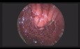 Un nuevo método de reparación de la fístula rectovesical: superposición de músculo rectal por TEM (microcirugía endoscópica transanal)