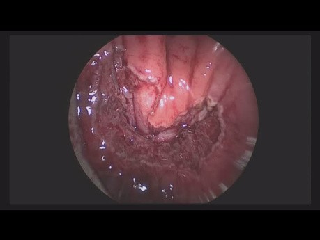 Un nuevo método de reparación de la fístula rectovesical: superposición de músculo rectal por TEM (microcirugía endoscópica transanal)
