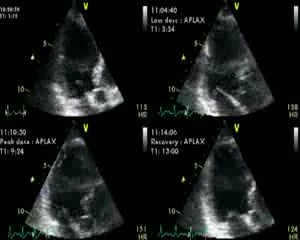 Ecocardiograma stress con dobutamina