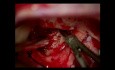Abordaje transcraneal para extirpar el tumor hipofisario