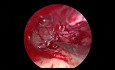 Timpanoplastia de revisión endoscópica para pérdida auditiva conductiva