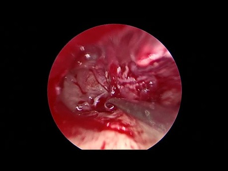 Timpanoplastia de revisión endoscópica para pérdida auditiva conductiva