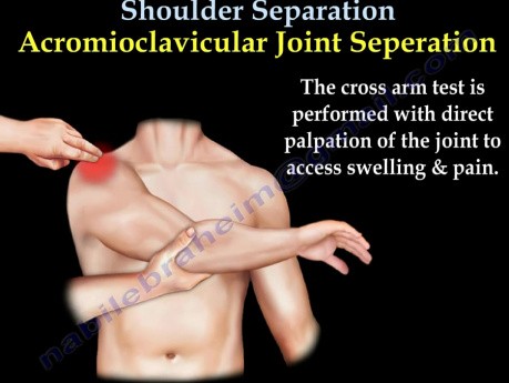 Separación del hombro - articulación acromioclavicular - video-clase