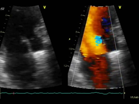 Perforación de la válvula mitral