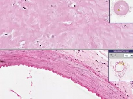 Recanalización de la arteria coronaria con ateroesclerosis - histopatología