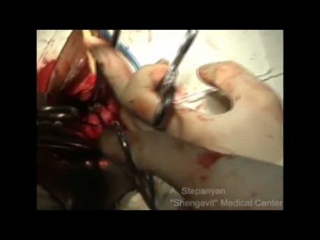 Morcelación durante una histerectomía vaginal