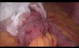 Prueba de fuga de derivación gástrica de una anastomosis