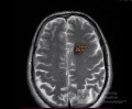 Estirpación de cavernoma subcortical 