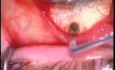 Glaucoma TCF, cirugía ABA con uso de cuchillo de Fugo