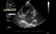 Válvula mitral mixomatosa con prolapso de la válvula mitral