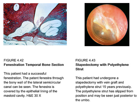 Enfermedades del oído - Volumen 4 La cápsula ótica