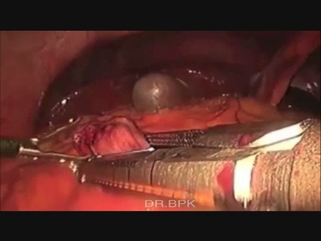 Diverticulectomía laparoscópica de Meckel