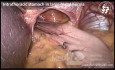 Estómago intratorácico en una hernia hiatal grande