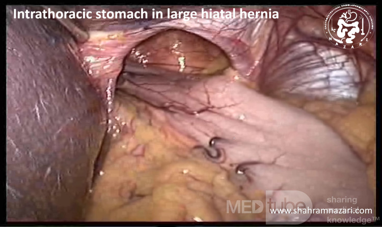 Estómago intratorácico en una hernia hiatal grande