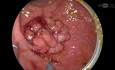 Microcirugía mínimamente invasiva (TEM) para el cáncer de recto. Abordaje quirúrgico paso a paso.