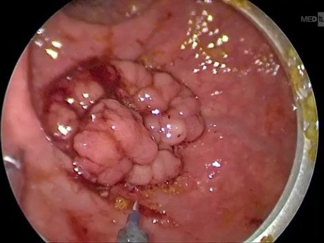 Microcirugía mínimamente invasiva (TEM) para el cáncer de recto. Abordaje quirúrgico paso a paso.