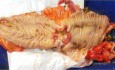 Cancer de colon sigmoide