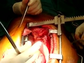Cabg: injerto de derivación de arteria coronaria con bomba despierto arterial total