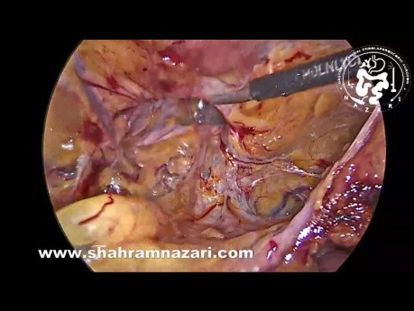 Reparación de hernia inguinal recurrente incisional izquierda