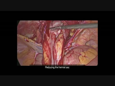 Hernioplastia - método TAPP - paso a paso