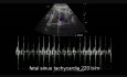 Caso de taquicardia sinusal del feto
