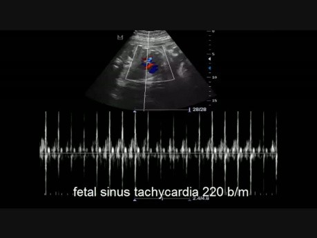 Caso de taquicardia sinusal del feto