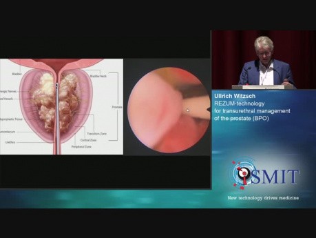 Tecnología REZUM para el manejo transuretral de la próstata - SMIT 2019