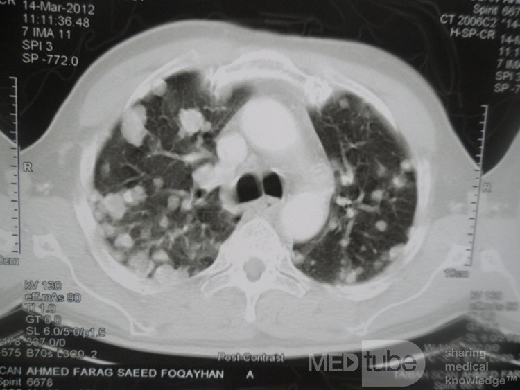 Metástasis torácica debida a carcinoma de células renales