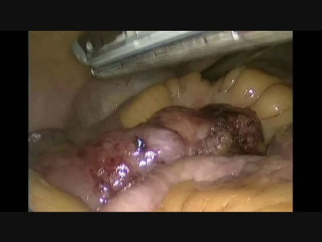 Resección laparoscópica del video sin cortar del divertículo de Meckel sangrante