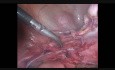 Histerectomía laparoscópica por dolor pélvico crónico