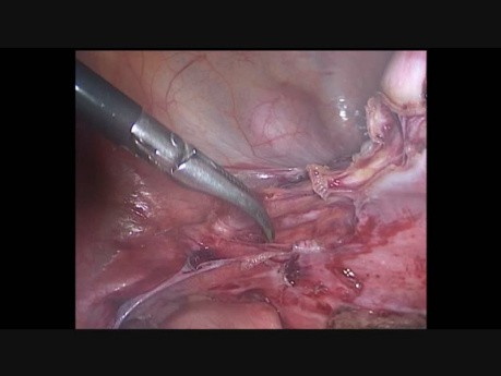 Histerectomía laparoscópica por dolor pélvico crónico